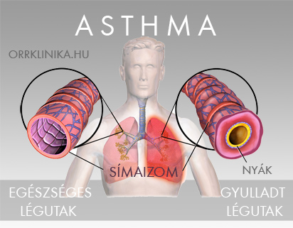 Asthma allergia gyulladas