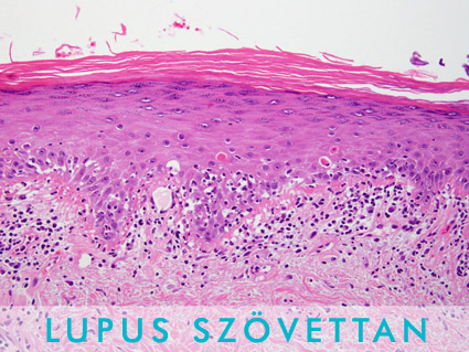 Lupus szovettan orr
