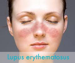 Orr Lupus erythematosus