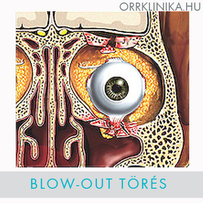 blow out tores luc caldwell mutet
