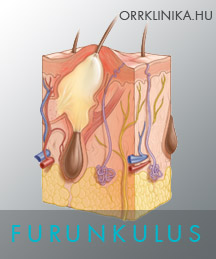 FURUNKULUS ORRGYULLADAS